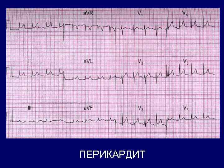 ПЕРИКАРДИТ 