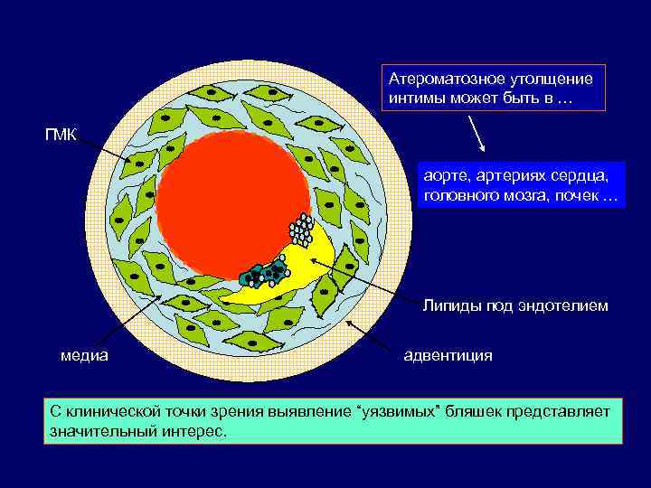 Атероматозное утолщение интимы может быть в … ГМК аорте, артериях сердца, головного мозга, почек