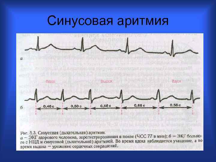 Синусовая аритмия сердца