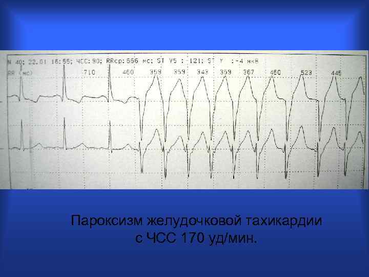 Пароксизм желудочковой тахикардии с ЧСС 170 уд/мин. 