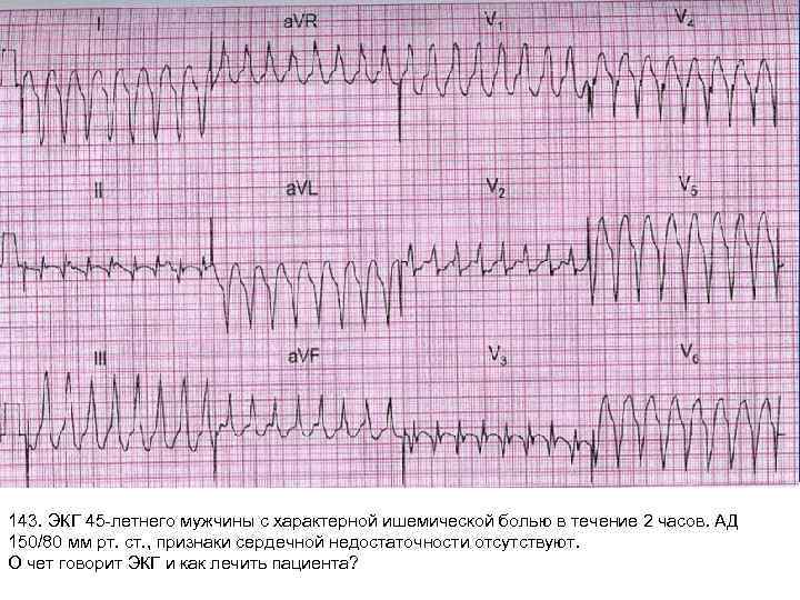 143. ЭКГ 45 -летнего мужчины с характерной ишемической болью в течение 2 часов. АД
