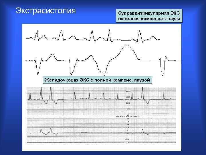 Экстрасистолия Суправентрикулярная ЭКС неполная компенсат. пауза Желудочковая ЭКС с полной компенс. паузой V 5