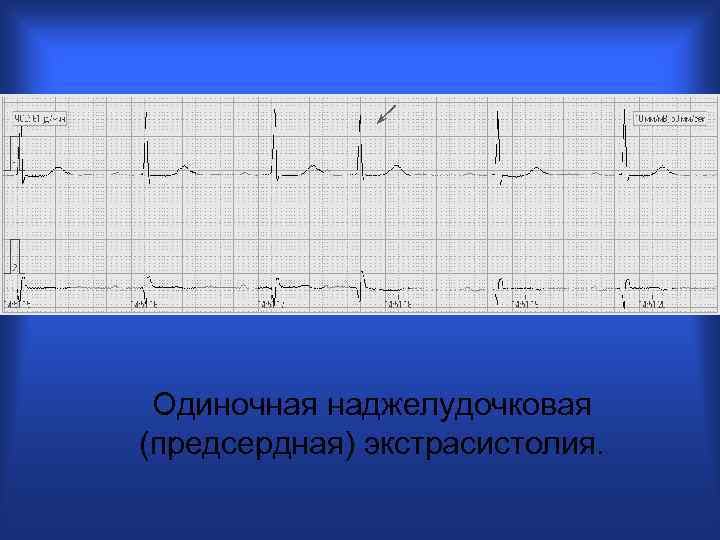 Одиночная наджелудочковая (предсердная) экстрасистолия. 