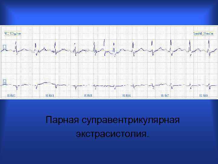 Парная суправентрикулярная экстрасистолия. 