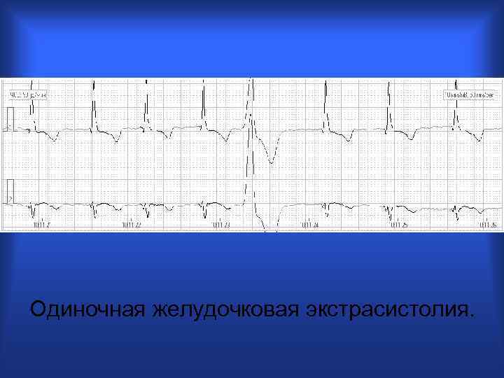 Одиночная желудочковая экстрасистолия. 