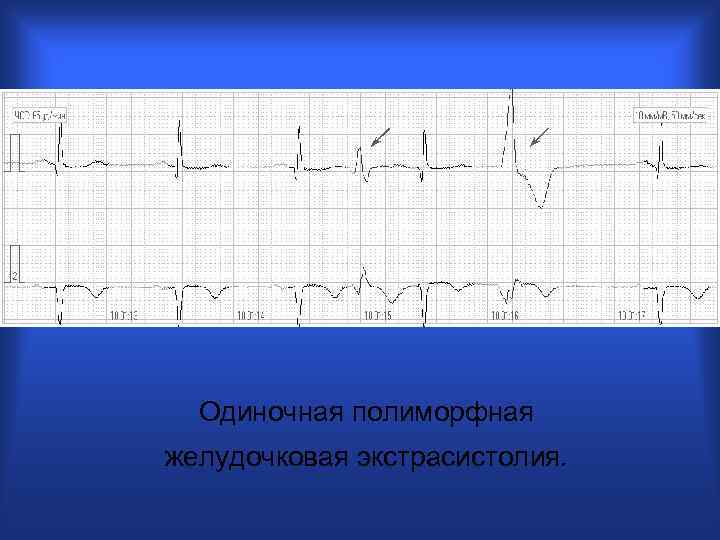 Одиночная полиморфная желудочковая экстрасистолия. 