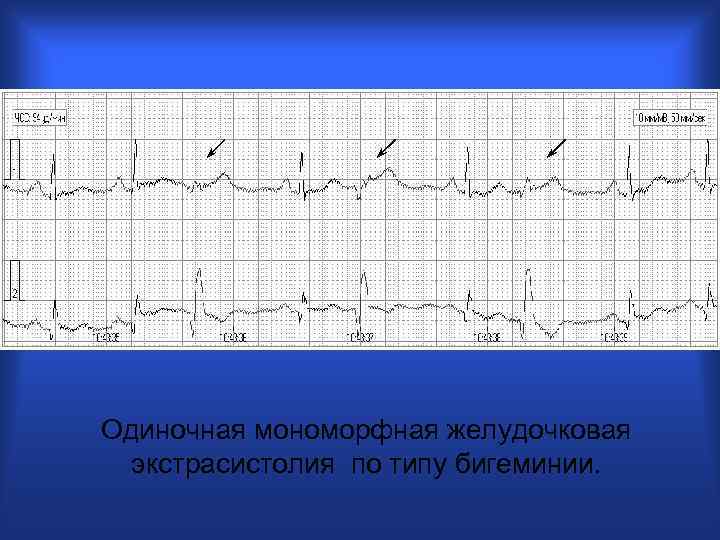 Одиночная мономорфная желудочковая экстрасистолия по типу бигеминии. 