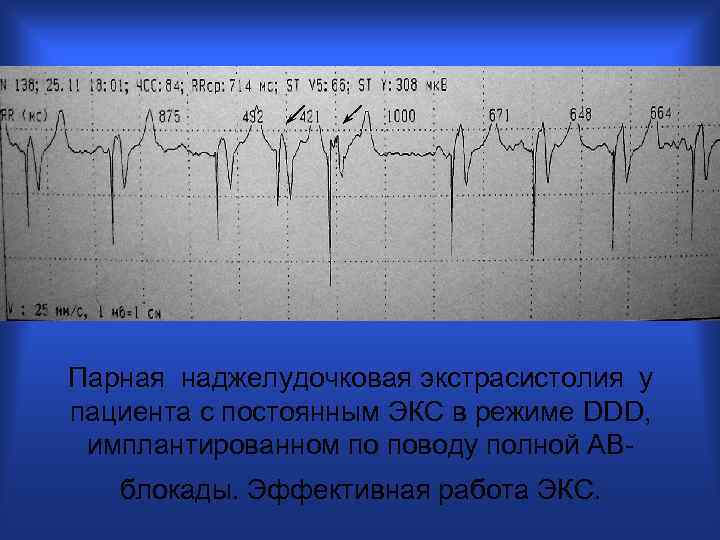 Парная наджелудочковая экстрасистолия у пациента с постоянным ЭКС в режиме DDD, имплантированном по поводу