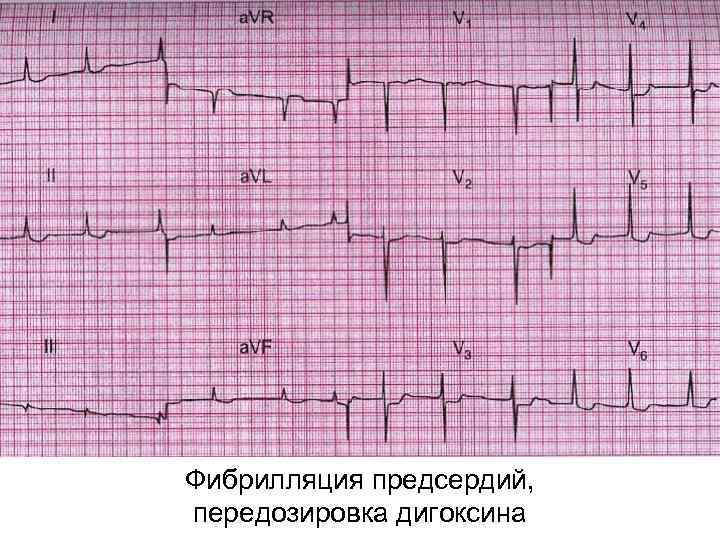 Фибрилляция предсердий, передозировка дигоксина 