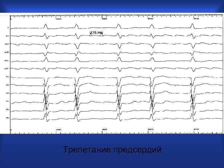 Трепетание предсердий 