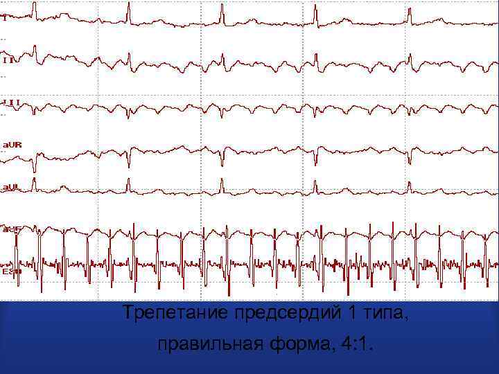 Трепетание предсердий 1 типа, правильная форма, 4: 1. 