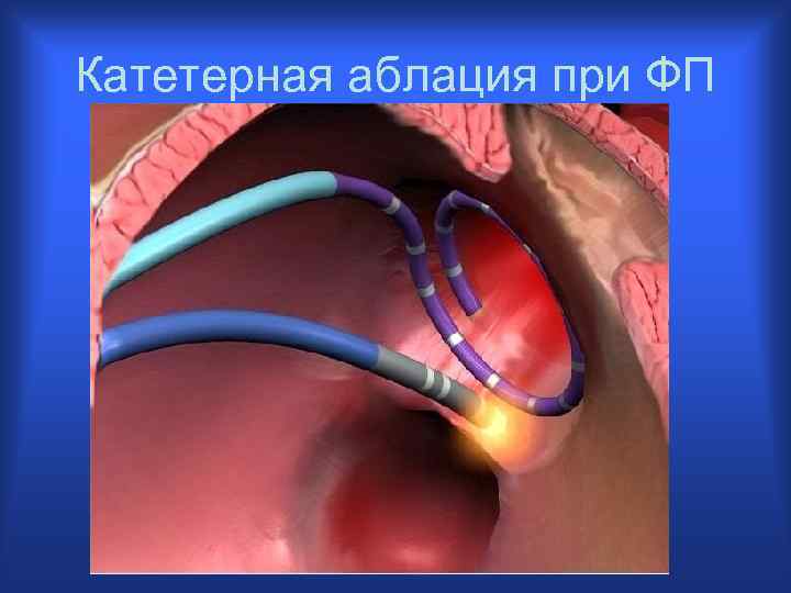 Абляция сердца при мерцательной. Радиочастотная катетерная абляция. Катетерная абляция фибрилляции предсердий. Катетерная абляция сердца.