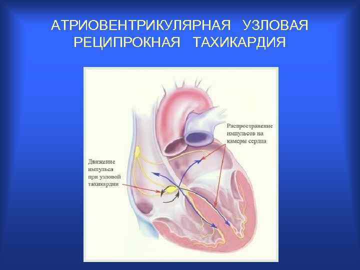 Открытый атриовентрикулярный канал презентация