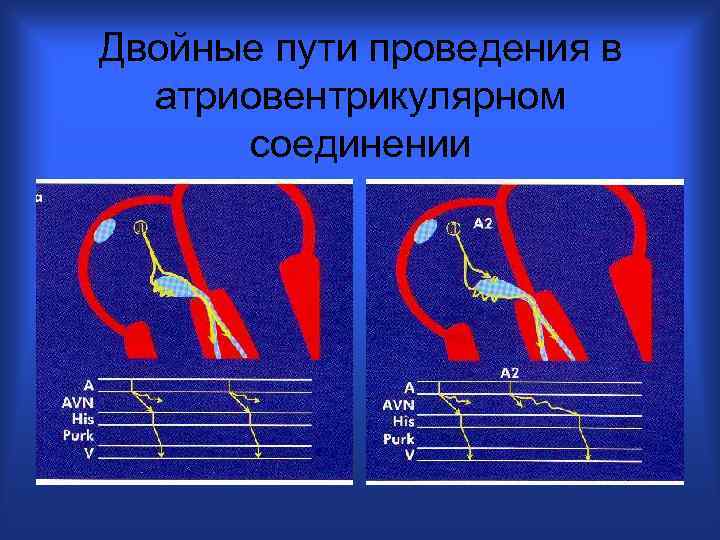 Двойные пути проведения в атриовентрикулярном соединении 