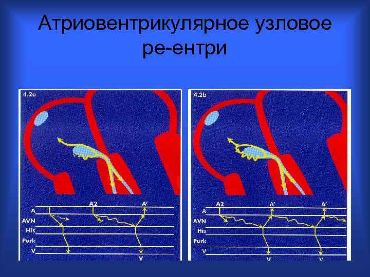 Атриовентрикулярное узловое ре-ентри 