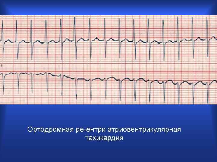 Ортодромная ре-ентри атриовентрикулярная тахикардия 