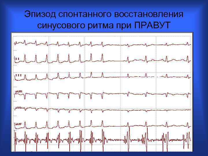 Эпизод спонтанного восстановления синусового ритма при ПРАВУТ 