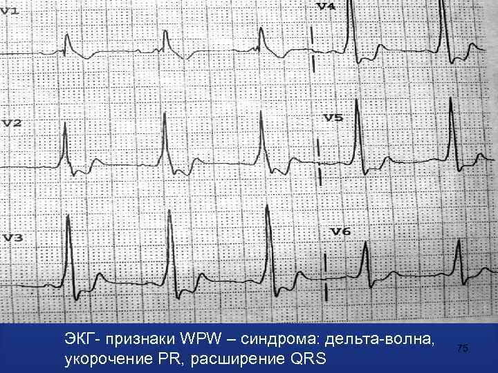 Wpw синдром на экг картинки