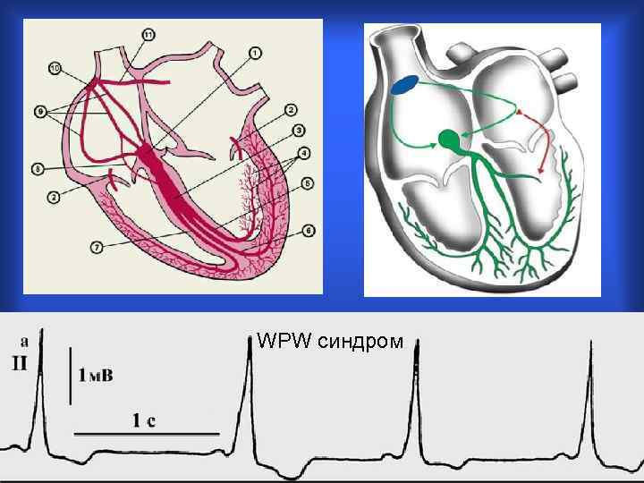 Wpw синдром на экг картинки