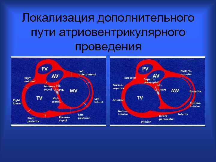 Локализация дополнительного пути атриовентрикулярного проведения 