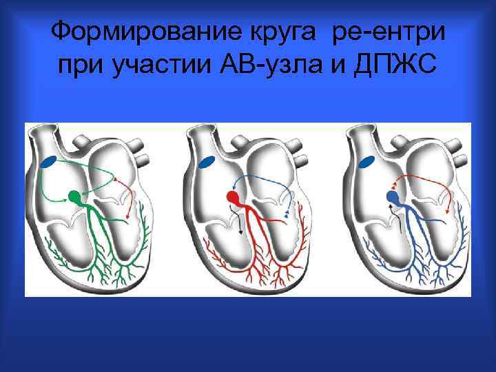 Формирование круга ре-ентри при участии АВ-узла и ДПЖС 