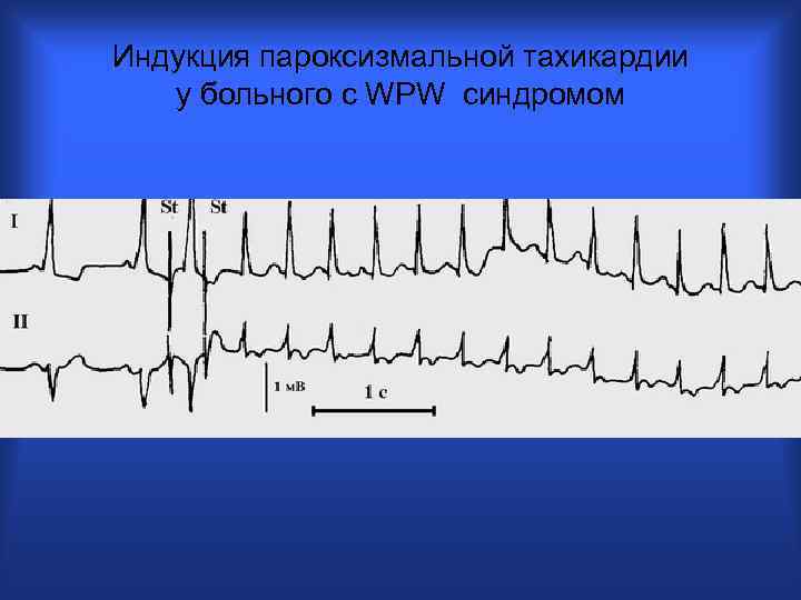 Индукция пароксизмальной тахикардии у больного с WPW синдромом 