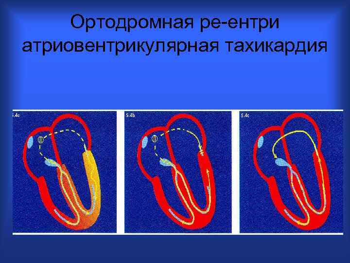 Ортодромная ре-ентри атриовентрикулярная тахикардия 