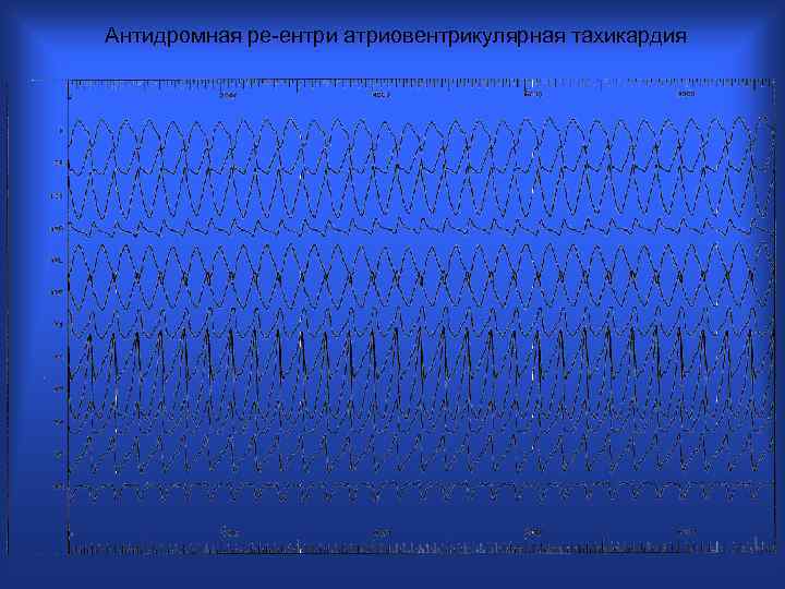 Антидромная ре-ентри атриовентрикулярная тахикардия 