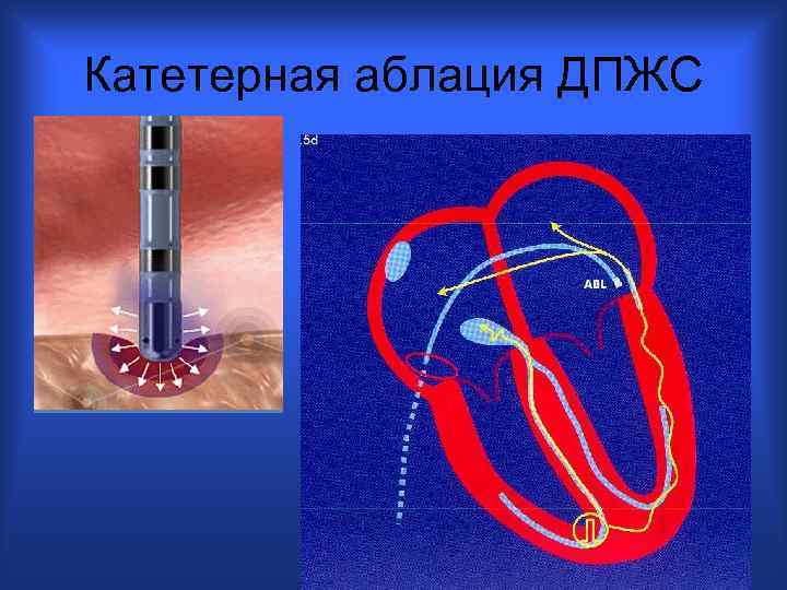 Катетерная аблация ДПЖС 