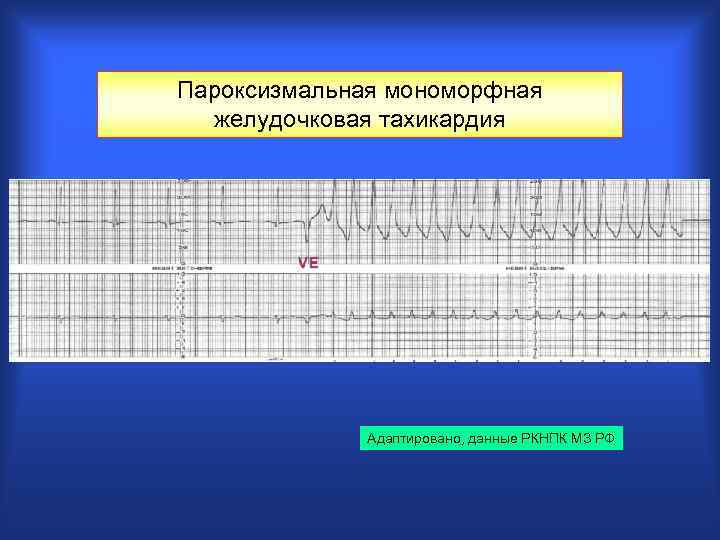 Пароксизмальная мономорфная желудочковая тахикардия Адаптировано, данные РКНПК МЗ РФ 