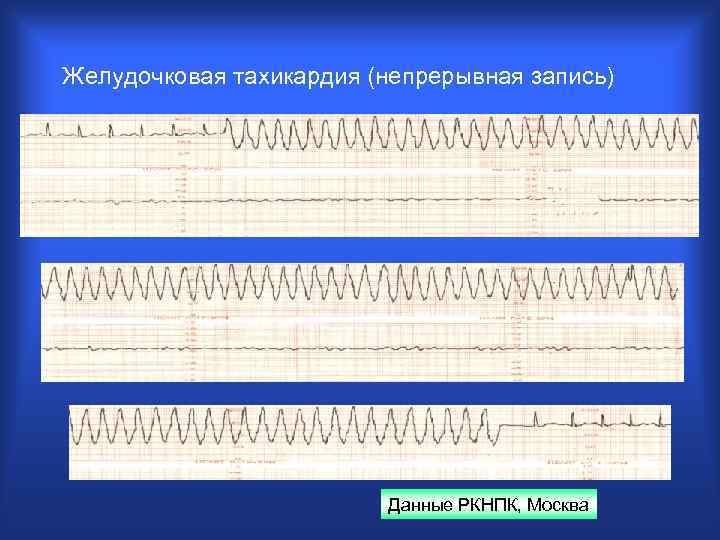 Желудочковая тахикардия (непрерывная запись) Данные РКНПК, Москва 