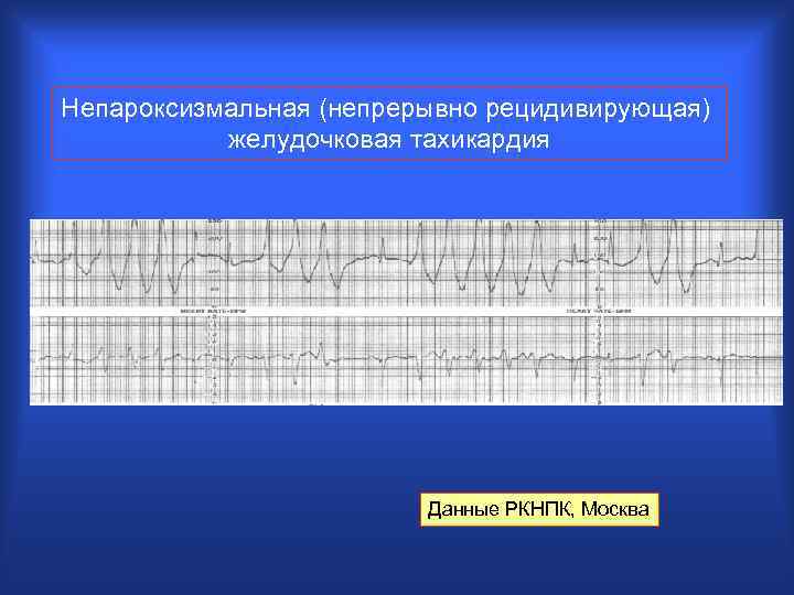 Непароксизмальная (непрерывно рецидивирующая) желудочковая тахикардия Данные РКНПК, Москва 