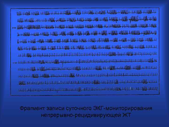 Фрагмент записи суточного ЭКГ-мониторирования непрерывно-рецидивирующей ЖТ 