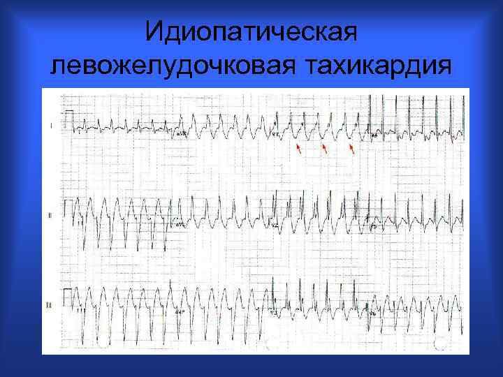 Идиопатическая левожелудочковая тахикардия 