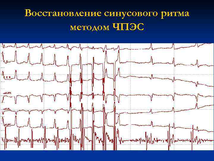 Восстановление синусового ритма методом ЧПЭС 