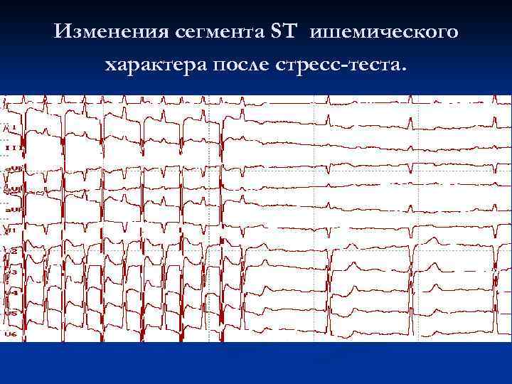 Изменения сегмента ST ишемического характера после стресс-теста. 