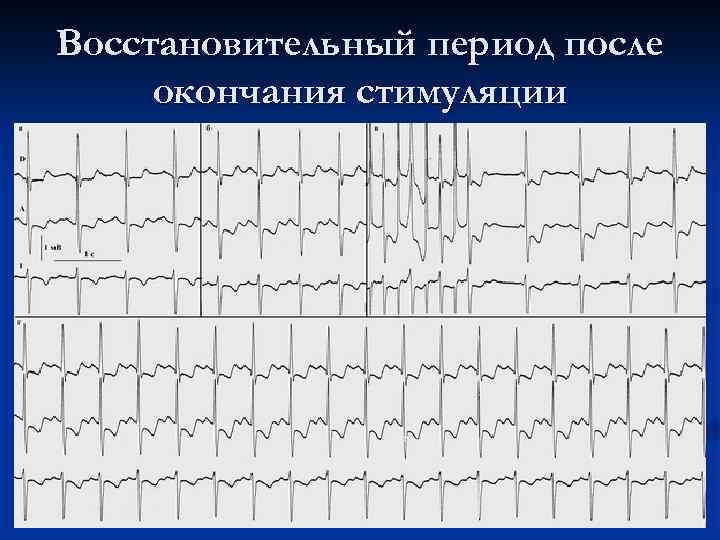 Восстановительный период после окончания стимуляции 