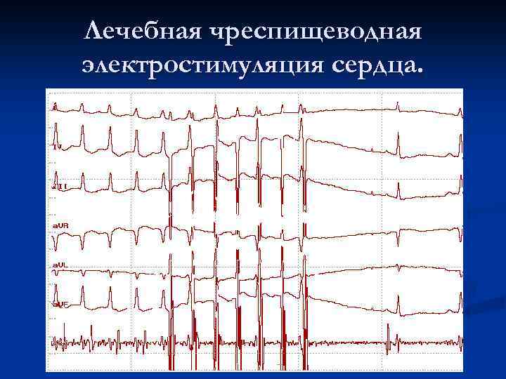 Лечебная чреспищеводная электростимуляция сердца. 