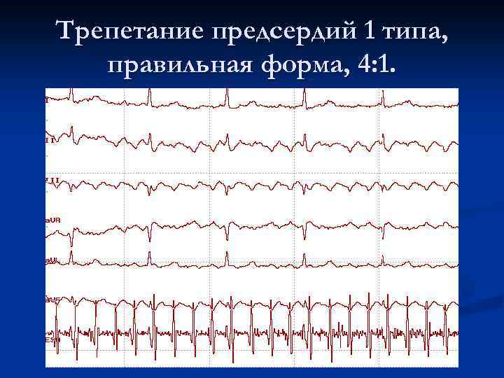 Трепетание предсердий 1 типа, правильная форма, 4: 1. 