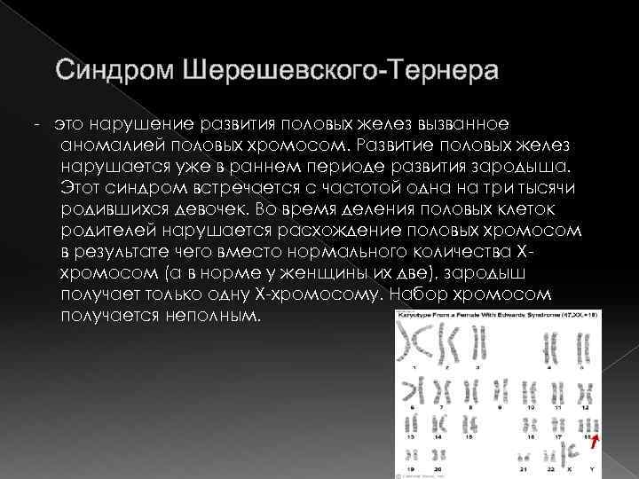 10 синдром шерешевского тернера. Синдром Шерешевского Тернера. Синдром Шерешевского Тернера родословная. Синдром Шерешевского-Тернера половое развитие. Схема возникновения синдрома Шерешевского-Тернера.