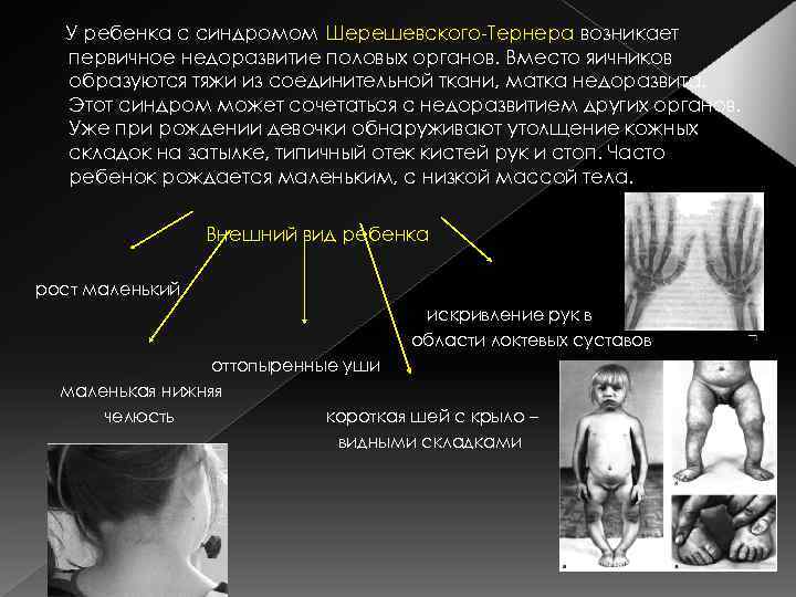 У ребенка с синдромом Шерешевского-Тернера возникает первичное недоразвитие половых органов. Вместо яичников образуются тяжи