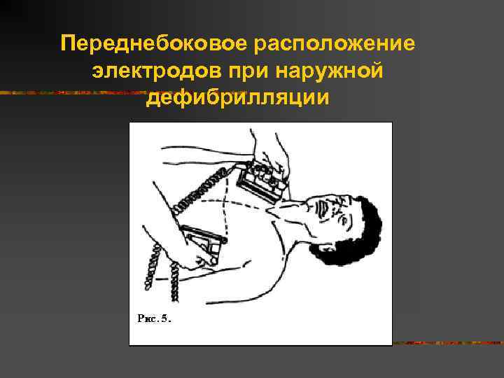 Переднебоковое расположение электродов при наружной дефибрилляции 