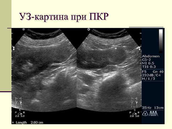 УЗ-картина при ПКР 