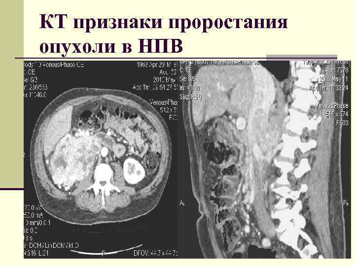 КТ признаки проростания опухоли в НПВ 