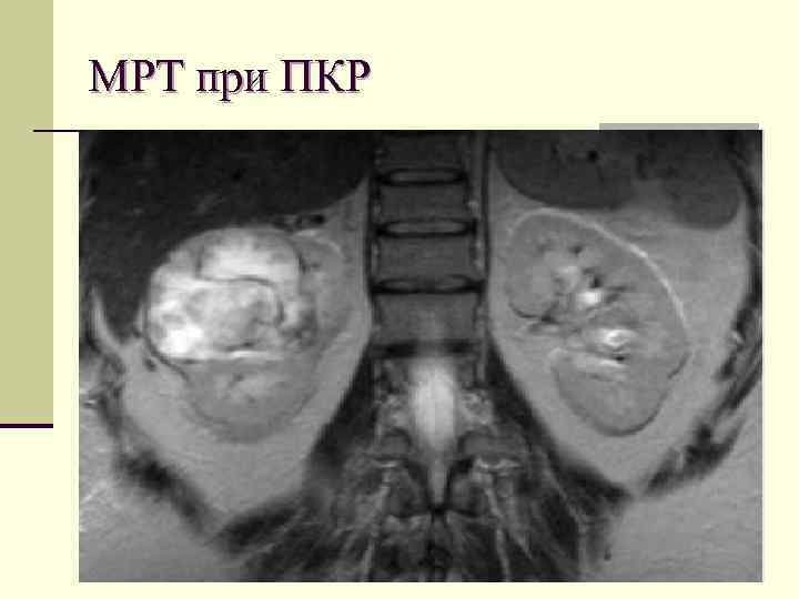 МРТ при ПКР 