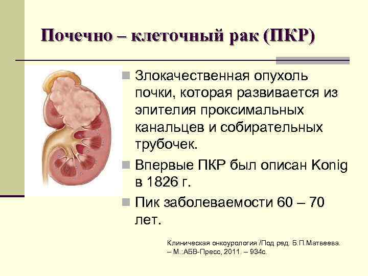 Почечно – клеточный рак (ПКР) n Злокачественная опухоль почки, которая развивается из эпителия проксимальных