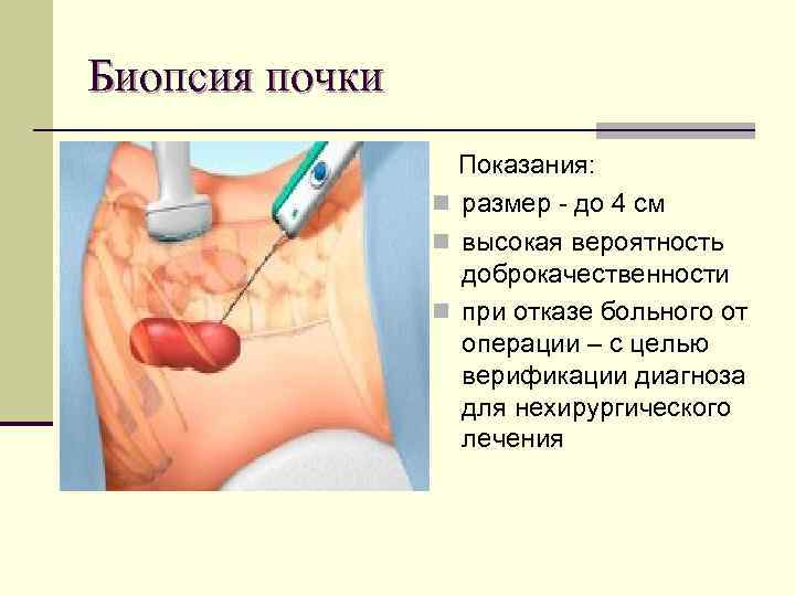 Биопсия почки Показания: n размер - до 4 см n высокая вероятность доброкачественности n