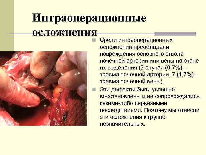 Интраоперационные осложнения Среди интраоперационных n осложнений преобладали повреждения основного ствола почечной артерии или вены
