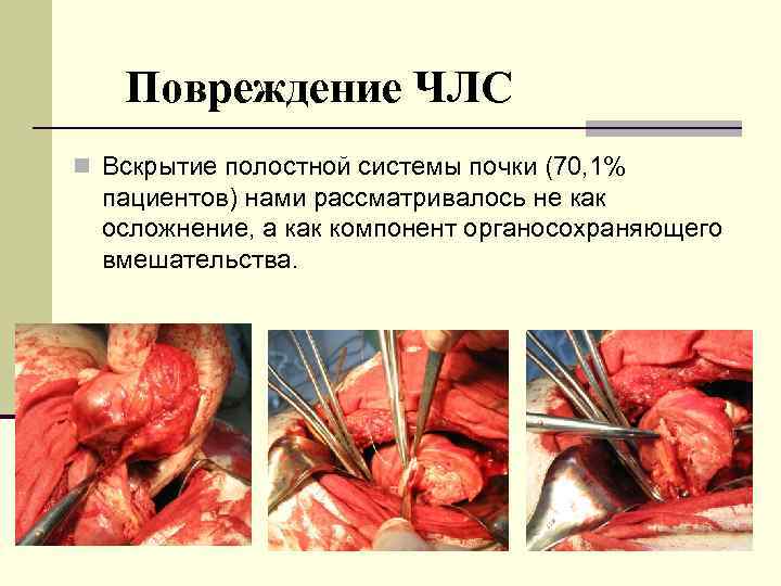 Повреждение ЧЛС n Вскрытие полостной системы почки (70, 1% пациентов) нами рассматривалось не как