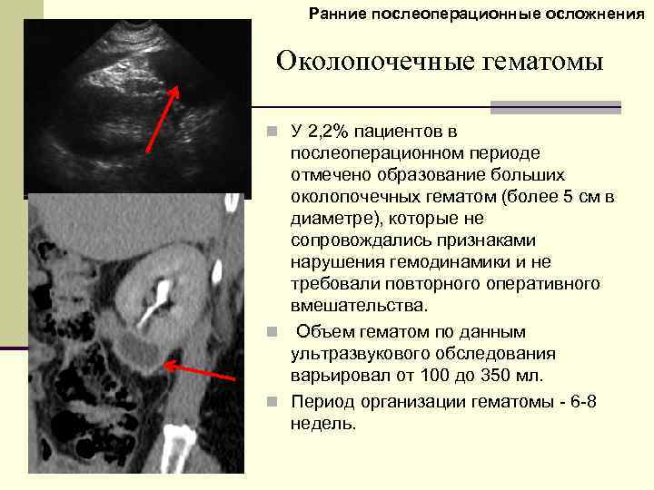Ранние послеоперационные осложнения Околопочечные гематомы n У 2, 2% пациентов в послеоперационном периоде отмечено
